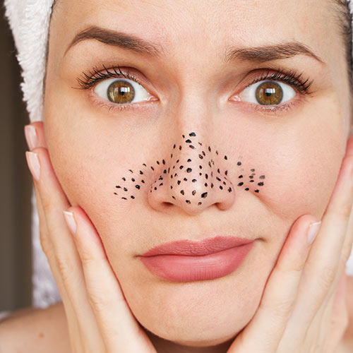 Blackheads removal facials